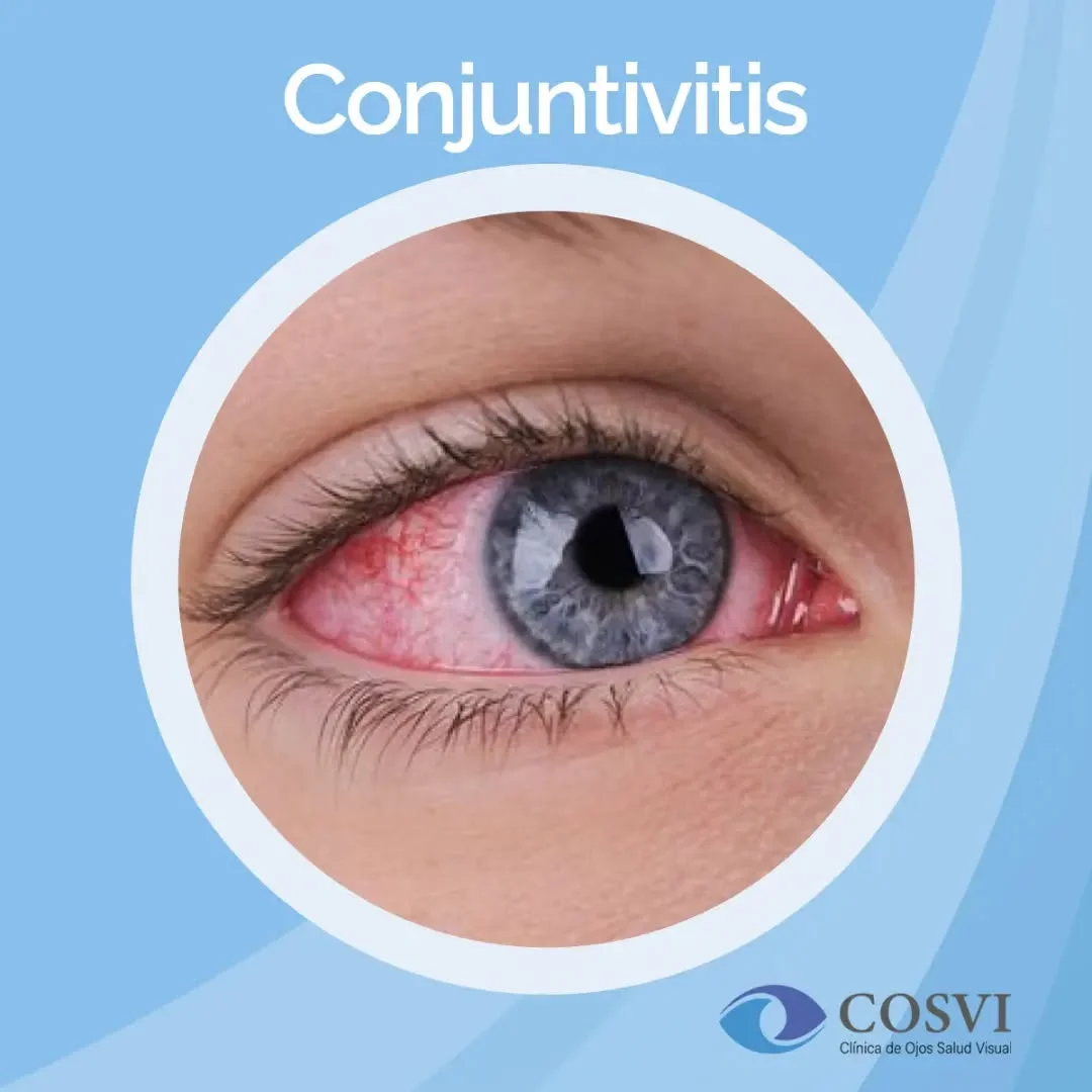 Conjuntivitis