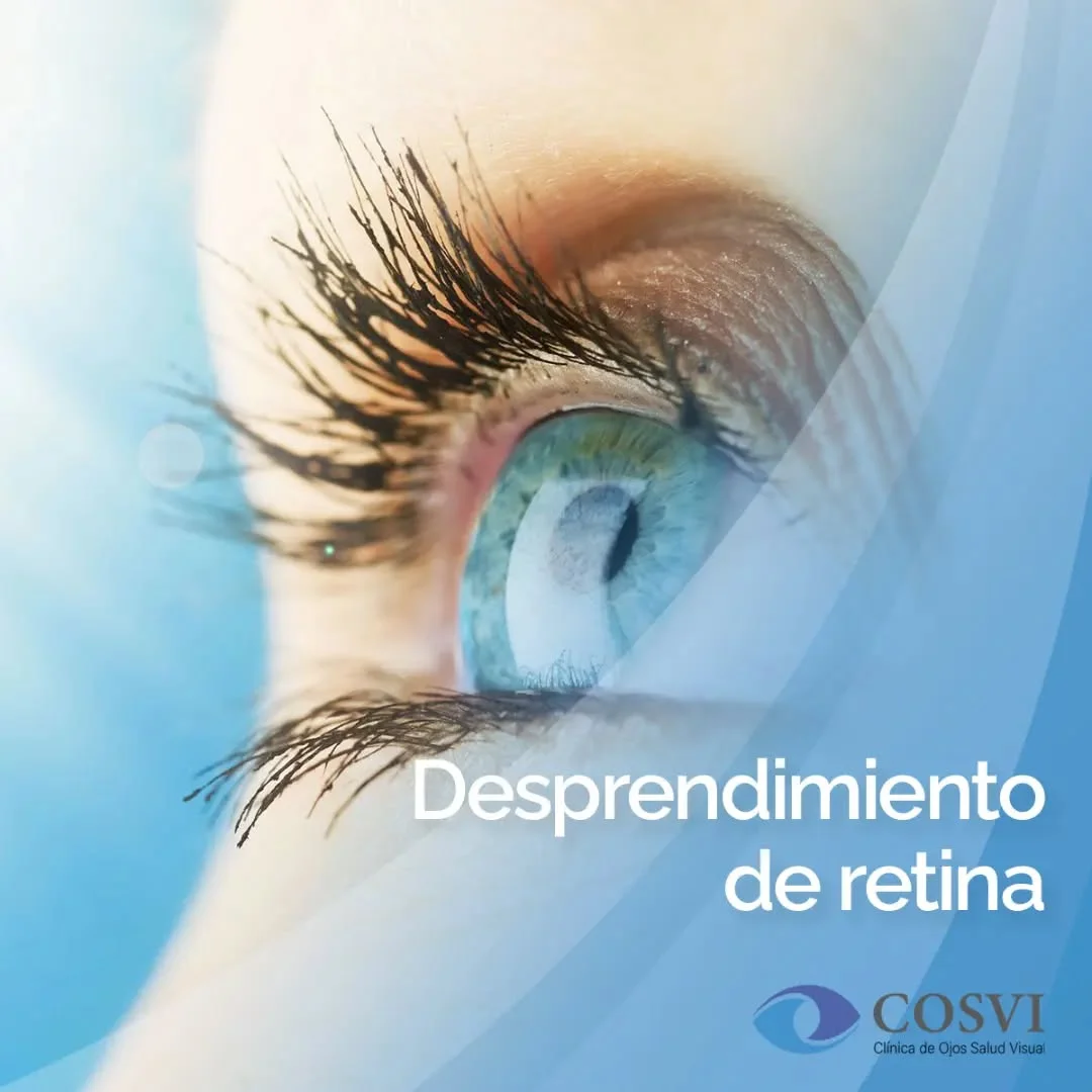 Desprendimiento de Retina